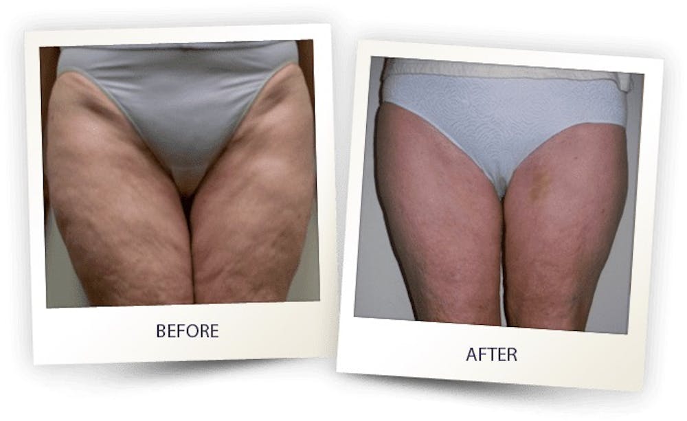 Body Before & After Gallery - Patient 3267397 - Image 1