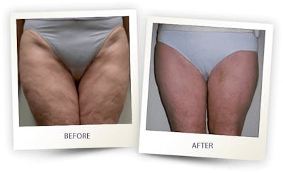 Body Before & After Gallery - Patient 3267397 - Image 1