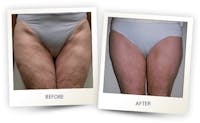 Body Before & After Gallery - Patient 3267397 - Image 1