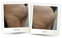 Body Before & After Gallery - Patient 3267398 - Image 1