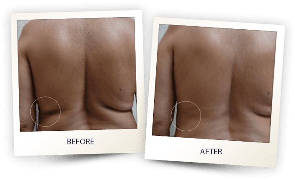 Body Before & After Gallery - Patient 3267399 - Image 1