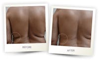 Body Before & After Gallery - Patient 3267399 - Image 1