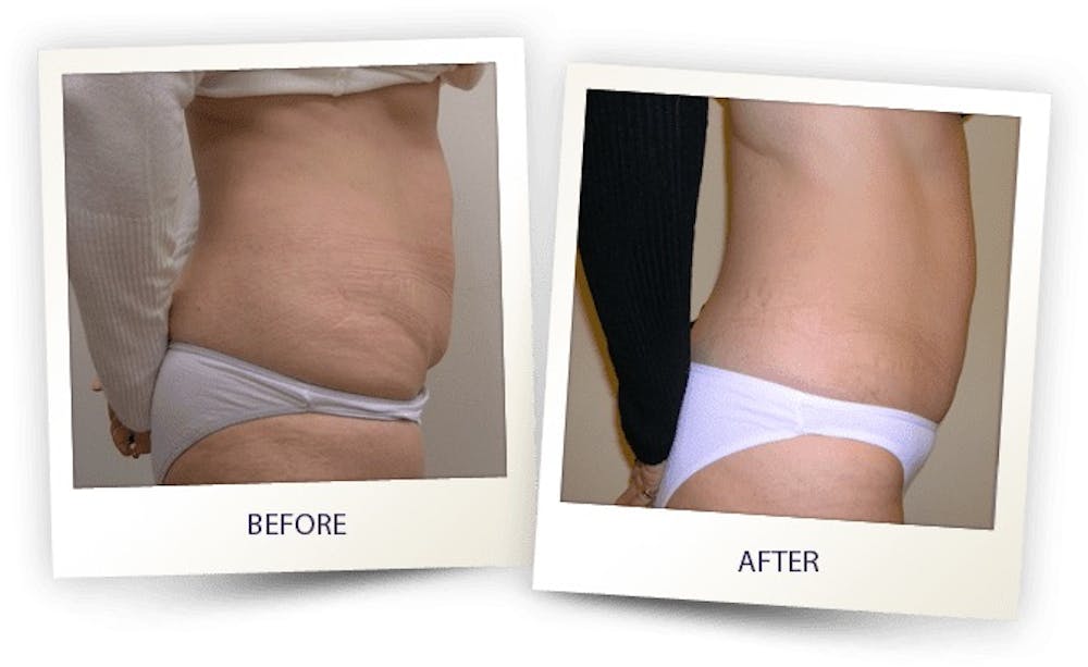 Body Before & After Gallery - Patient 3267401 - Image 1