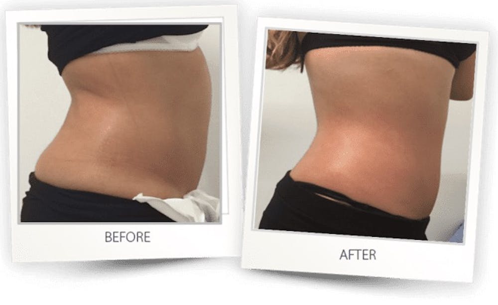 Body Before & After Gallery - Patient 3267404 - Image 1