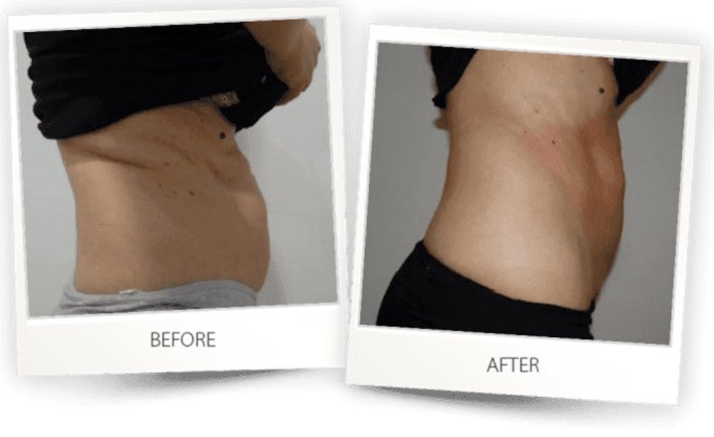 Body Before & After Gallery - Patient 3267406 - Image 1