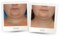 Face Before & After Gallery - Patient 3267422 - Image 1