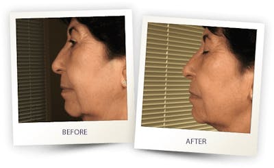Face Before & After Gallery - Patient 3267423 - Image 1
