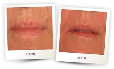Face Before & After Gallery - Patient 3267425 - Image 1