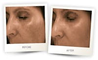 Face Before & After Gallery - Patient 3267428 - Image 1