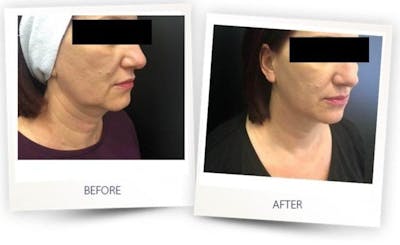 Face Before & After Gallery - Patient 3267429 - Image 1