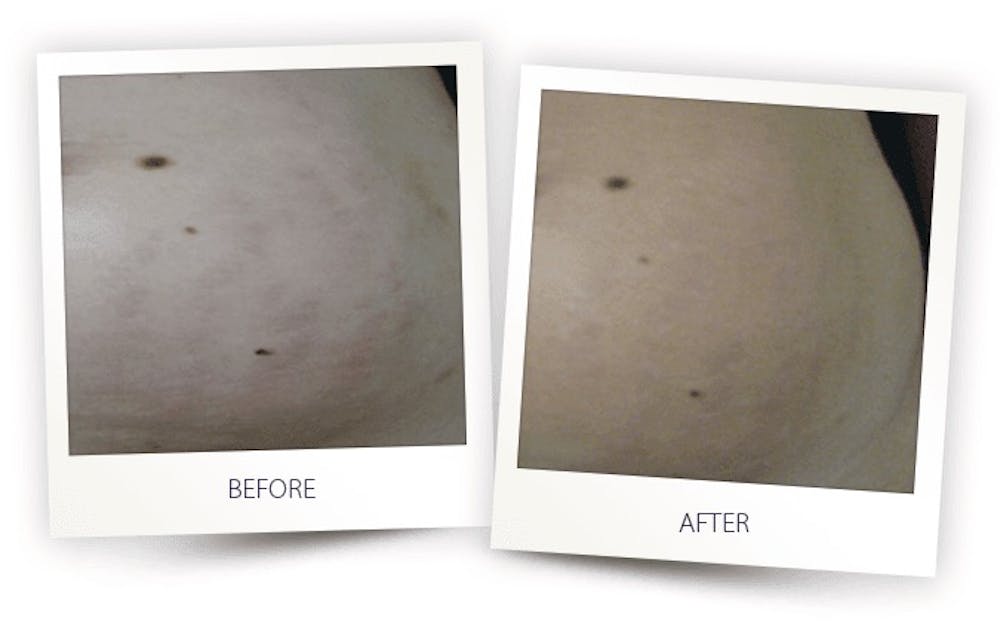 Body Before & After Gallery - Patient 3376258 - Image 1