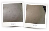 Body Before & After Gallery - Patient 3376258 - Image 1
