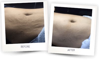 Body Before & After Gallery - Patient 3376260 - Image 1