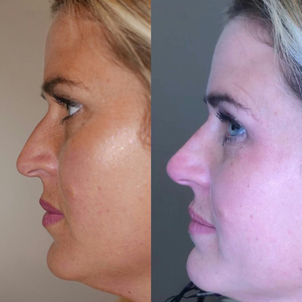 Nose Before & After Gallery - Patient 3376191 - Image 1