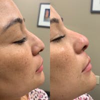 Nose Before & After Gallery - Patient 3376192 - Image 1