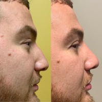 Nose Before & After Gallery - Patient 3376193 - Image 1