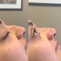 Nose Before & After Gallery - Patient 3376194 - Image 1