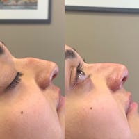 Nose Before & After Gallery - Patient 3376194 - Image 1