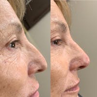 Nose Before & After Gallery - Patient 3376195 - Image 1