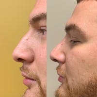 Nose Before & After Gallery - Patient 3376196 - Image 1