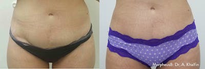 Morpheus 8 Laser Before & After Gallery - Patient 4489337 - Image 1