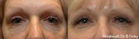 Morpheus 8 Laser Before & After Gallery - Patient 4489338 - Image 1