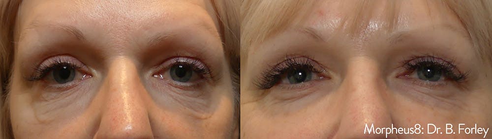 Morpheus 8 Laser Before & After Gallery - Patient 4489338 - Image 1