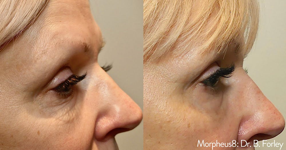 Morpheus 8 Laser Before & After Gallery - Patient 4489339 - Image 1