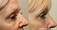Morpheus 8 Laser Before & After Gallery - Patient 4489339 - Image 1
