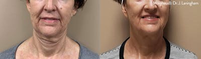 Morpheus 8 Laser Before & After Gallery - Patient 4489340 - Image 1