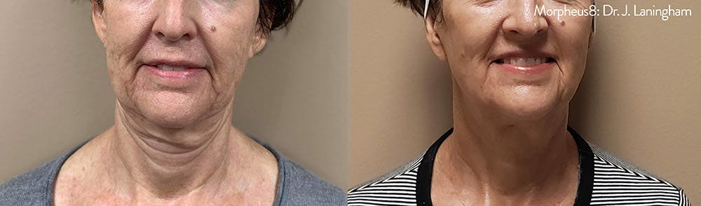 Morpheus 8 Laser Before & After Gallery - Patient 4489340 - Image 1