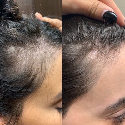 PRP Hair Before & After Gallery - Patient 3199662 - Image 2