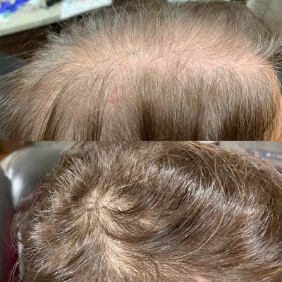PRP Hair Before & After Gallery - Patient 3199663 - Image 1