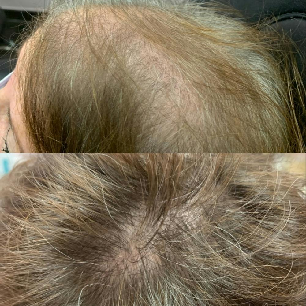 PRP Hair Before & After Gallery - Patient 3199663 - Image 2