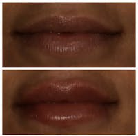 Lips Before & After Gallery - Patient 5809365 - Image 1