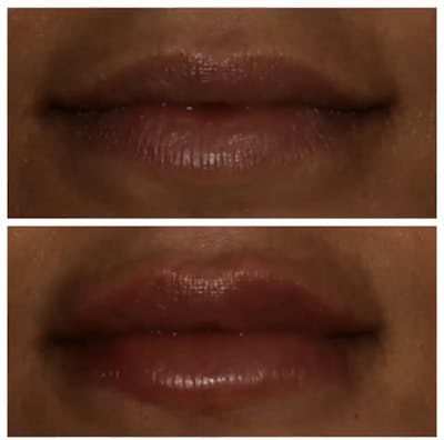 Lips Before & After Gallery - Patient 5809365 - Image 1