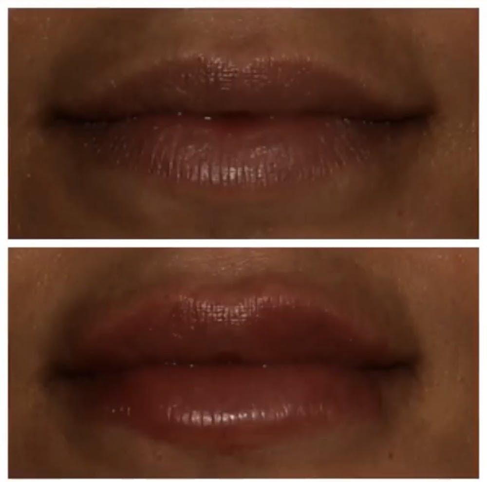 Lips Before & After Gallery - Patient 5809365 - Image 1