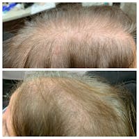 PRP Hair Before & After Gallery - Patient 5809386 - Image 1