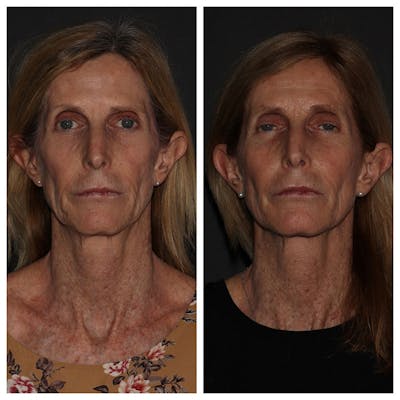 Instalift Threading Before & After Gallery - Patient 5809404 - Image 1