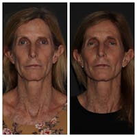 Instalift Threading Before & After Gallery - Patient 5809404 - Image 1