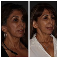 Instalift Threading Before & After Gallery - Patient 5825853 - Image 1
