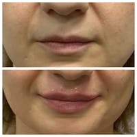 Lips Before & After Gallery - Patient 5891074 - Image 1