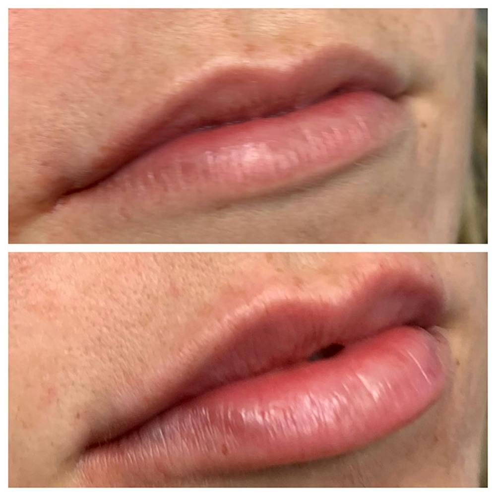 Lips Before & After Gallery - Patient 5891075 - Image 1