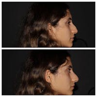 Nose Before & After Gallery - Patient 5930598 - Image 1