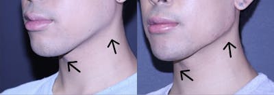 Jawline Before & After Gallery - Patient 6096352 - Image 1