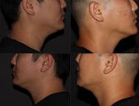 Jawline Before & After Gallery - Patient 6096363 - Image 1