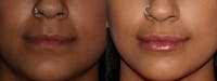 Lips Before & After Gallery - Patient 6096527 - Image 1