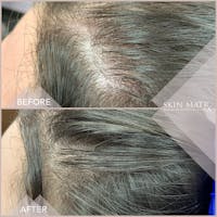 PRP Hair Before & After Gallery - Patient 16859175 - Image 1