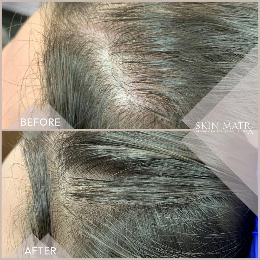 PRP Hair Before & After Gallery - Patient 16859175 - Image 1