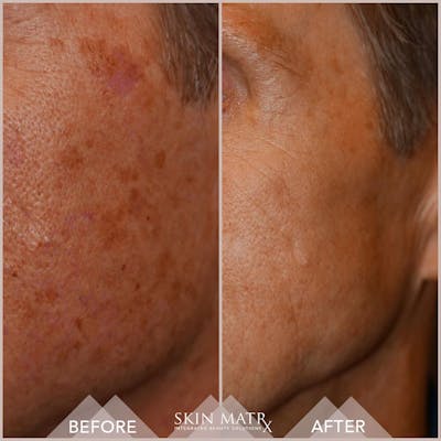 IPL Before & After Gallery - Patient 16859185 - Image 1